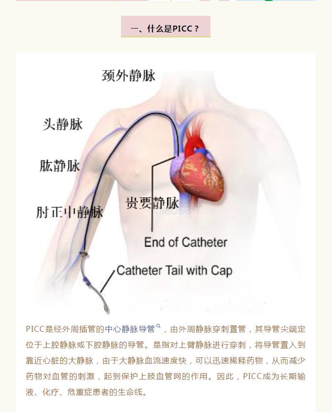 PICC：细细的导管 长长的“生命线”