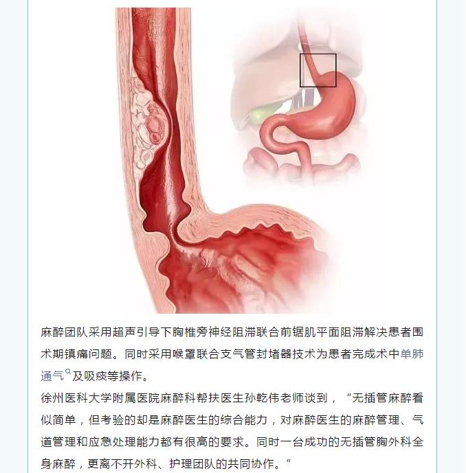 丰县人民医院麻醉科再添新技术，进一步推进舒适化医疗服务