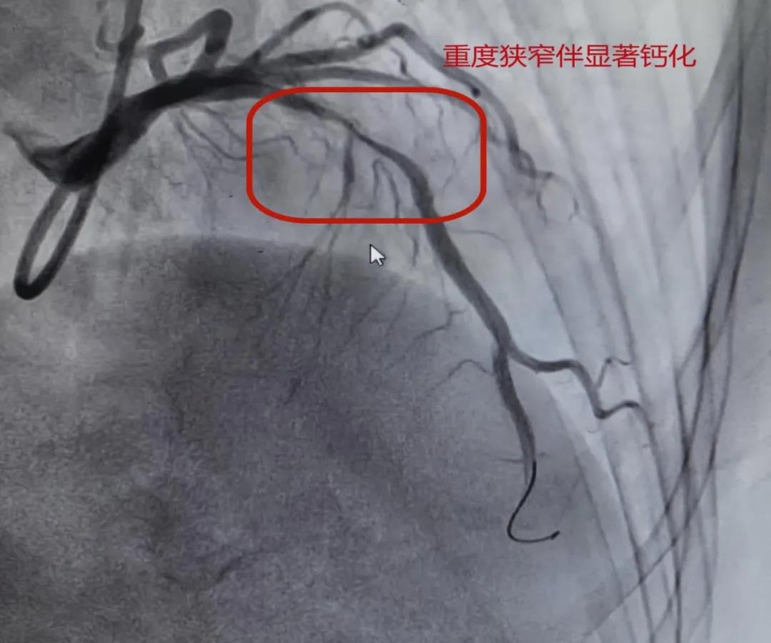 “慧眼”识钙化，“旋磨”除顽石