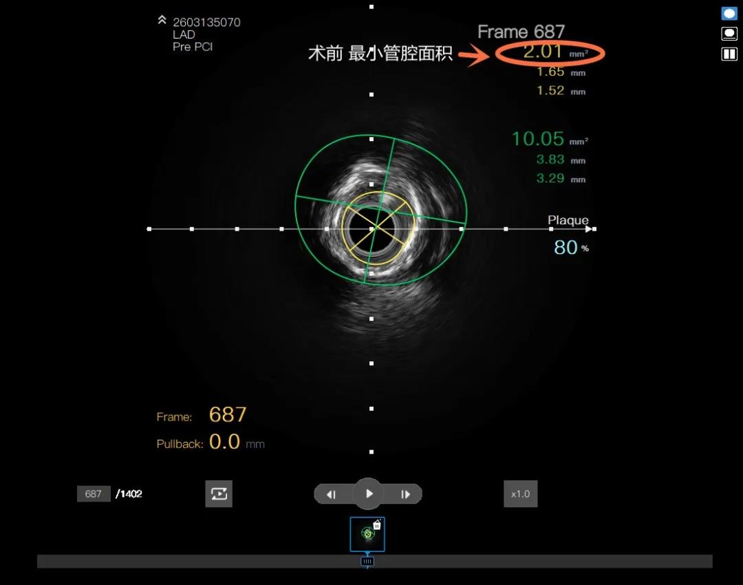 “慧眼”识钙化，“旋磨”除顽石