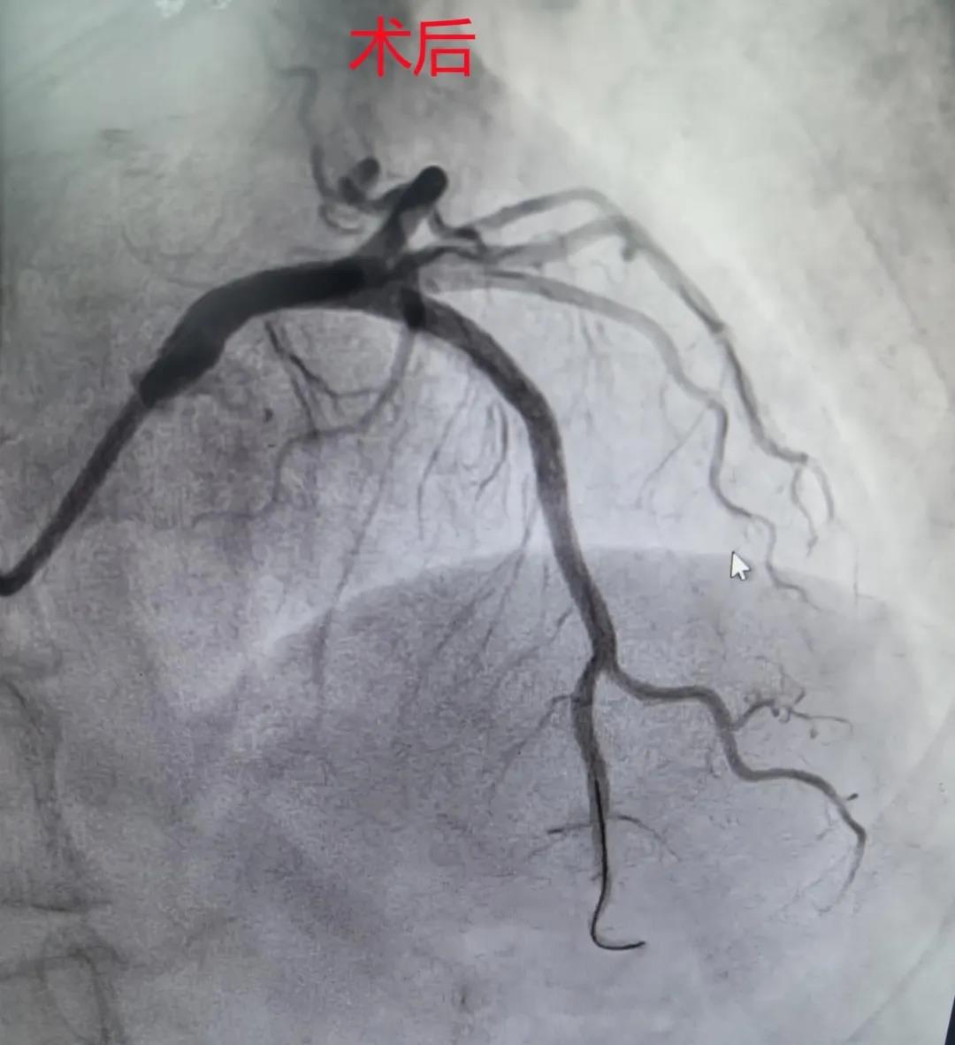 “慧眼”识钙化，“旋磨”除顽石