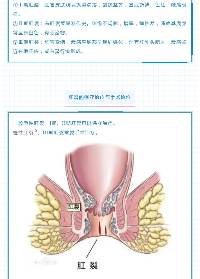 痛苦的难言之隐——肛裂